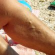 Painful varicose veins